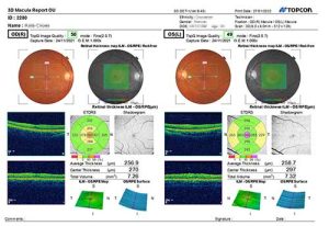 Patient-Macula-OCT1